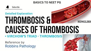 Thrombosis  Causes of Thrombosis  Thrombus  Thrombus vs Embolus  Hemostasis vs Thrombosis  KTC [upl. by Michi]