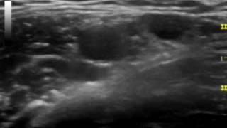 Axillary Ultrasound Anatomy [upl. by Boyt]