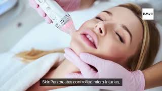 SkinPen Microneedling for Acne Scars in Dallas TX  Achieve Smooth Clear Skin [upl. by Egiap349]