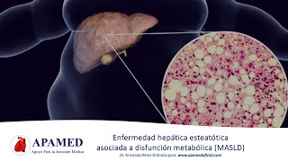 Esteatosis hepática asociada a disfunción metabólica MASLD NAFLD [upl. by Keelin]