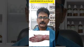 जलने की समस्या को कैसे ठीक करें burn homeopathicmedicine shorts [upl. by Leilah]