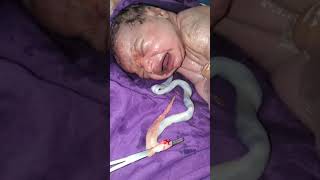 Vernix lot of 2 meters Newborn baby nurse and doctor cleaning it with soap and spinal cords cutt [upl. by Brasca221]