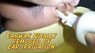 Hard Earwax Finally Removed by Ear Irrigation After 5 days of Ear wax Softener [upl. by Wilcox]