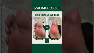 Viral Exfoliation Solutions for Thick Feet Skin amp Calluses at Home  Instant Foot Peel bestways [upl. by Ramahs]