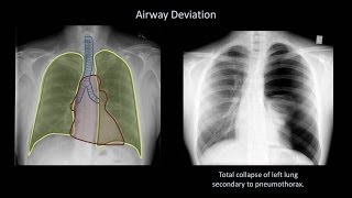 How to Interpret a Chest XRay Lesson 4  Airways Bones and Soft Tissues [upl. by Lynd]