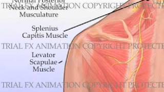 Trigger Point Injections [upl. by Silbahc587]