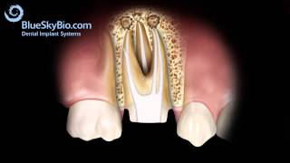 Patient Treatment Videos Root Canal Retreatment [upl. by Nyleda]