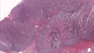 Colon Adenocarcinoma  Microscopic Diagnosis and Molecular Testing [upl. by Mieka]