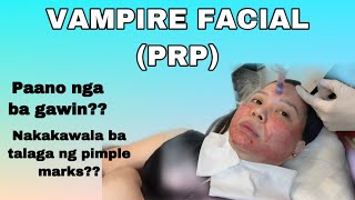 VAMPIRE FACIAL  PRP TREATMENT [upl. by Asilat]