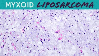 Myxoid Liposarcoma explained in 5 minutes basic soft tissue pathology sarcoma pathologists [upl. by Etteinotna]