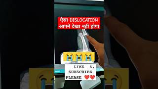 ऐसा Finger Dislocation आपने देखा नही होगा lfingerdislocationdislocateddislocationradiologycareer [upl. by Krystin]