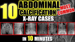 Abdominal Calcifications on XRay  10 Most Common radiology [upl. by Thibaud459]