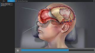 Traumatic Brain Injury  Brain Surgery Animation [upl. by Anelej]