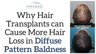 Why Hair Transplants can Cause More Hair Loss in Diffuse Hair Thinning and Alternative Treatments [upl. by Ardolino]