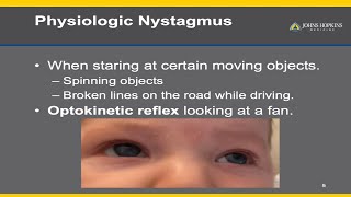 Nystagmus  A Patient Guide [upl. by Zetnom]