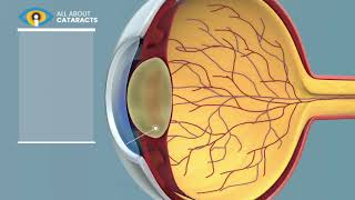 What is a Cataract  Cataract surgery video [upl. by Navak213]