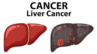 LIVER CANCER BSC NURSINGdailypost [upl. by Aliber]