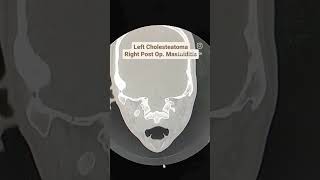 Cholesteatoma with Mastoiditis CT Temporal Bones [upl. by Ardy]