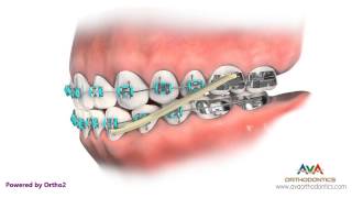 Orthodontics Treatment for Underbite or Crossbite  Rubber Bands [upl. by Lenoil]