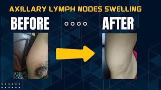 Case of Axillary lymph nodes swelling [upl. by Lusar394]