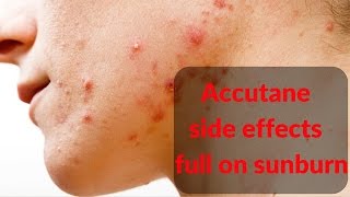 Accutane side effects sunburn [upl. by Autum]