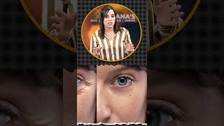 EASILY TREAT CROWS FEET WRINKLES  DRPOOJA KASANA [upl. by Nnaeirual]