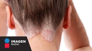 ¿Qué es y cómo se trata la psoriasis  Bien y Saludable [upl. by Cindelyn]