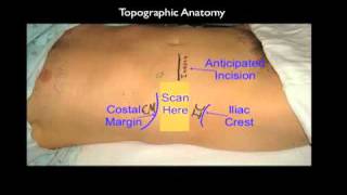 Transversus Abdominis Plane TAP Block Ultrasound Guided [upl. by Anerat]