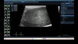 IQ 306 LIVER HEPATOMA ULTRASOUND ECHOPAC ANALYSIS [upl. by Ettenoj646]