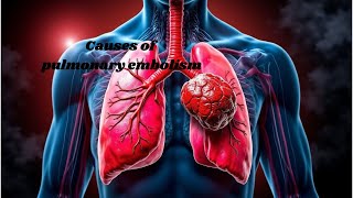 What causes pulmonary embolism Understanding the risks [upl. by Suirradal]