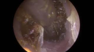 Soft Plug of Ear Wax Extracted by Microsuction  483 [upl. by Ennoryt89]