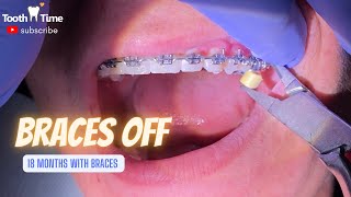 Braces Off  For how long should I wear retainers   How Clear Retainers are made Tooth Time [upl. by Daiz]