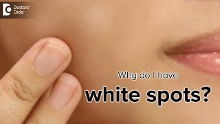 What is the cause of white spots on the skin  Dr Rasya Dixit [upl. by Eibbor]