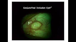 Conjunctival Inclusion Cyst Removal  Alka Netralaya  Dr Sunil Ugale [upl. by Justinn]