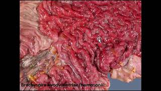 Gross Path of the GI Tract 14  Bacterial Dz of the Lg Intestine [upl. by Eerihs]