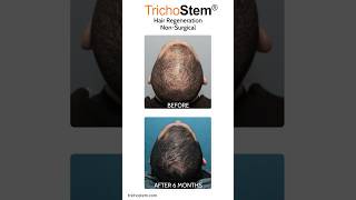 Why Thickening Thinning Covers More Scalp than a Hair Transplant thinninghair [upl. by Weisbrodt]