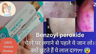 benzoyl peroxide gel 25  benzoyl peroxide gel Persol AC 25 review gel acne skincare [upl. by Ameline385]