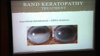 Band Keratopathy Interstitial Keratitis [upl. by Christiana]