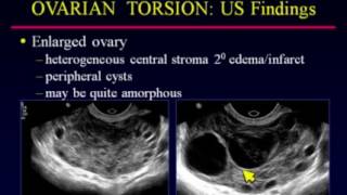 Sonographic Evaluation of Ovarian Torsion [upl. by Auos]