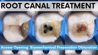 Root Canal Treatment🔵Mandibular 2nd Molar🟡Access Opening🟢 Biomechanical Preparation⚪️Obturation [upl. by Nawuq961]