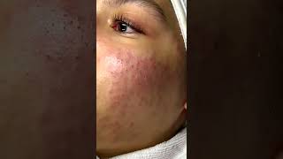 Cystic acne and blackheads removal  Newest pimple pops for 2022 [upl. by Adnilahs]