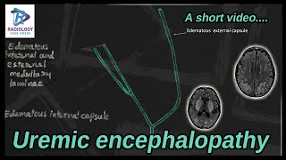 UREMIC ENCEPHALOPATHY Lentiform fork sign End renal disease Umamaheshwar ReddyV [upl. by Bounds]