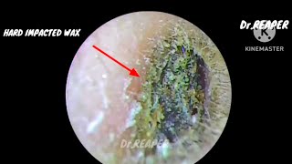 SATISFYING HARD IMPACTED EAR WAX REMOVAL IS IT INFECTED OR NORMAL 🙄🙄 [upl. by Anela]