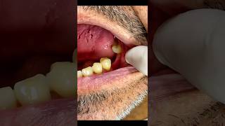 Flexible palatefree dental prosthesis mrdent dentalesthetics dentalclinic smile dentist viral [upl. by Lleon]