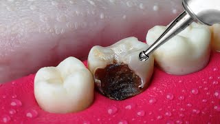 ASMR Restoration Incredible Tooth Cavity And The Master Dentist [upl. by Romanas941]