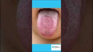 Treatment for Geographic Tongue and 4 Best Practices [upl. by Haidabo]