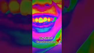 SMILE Transformation in one appointment [upl. by Idrahs]