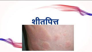 Sheetapitta  Urticaria Ayurvedic view  Treatment of Sheetapitta  Allergic reactions [upl. by Misty347]