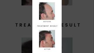 PRP Hair Treatment  prp hair loss treatment before and after  hairloss treatment prpforhairloss [upl. by Horten]