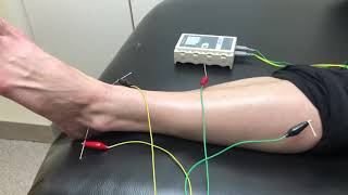 Acupuncture for Plantar Fasciitis at MN Spine and Sport in Woodbury Minnesota [upl. by Sekyere]